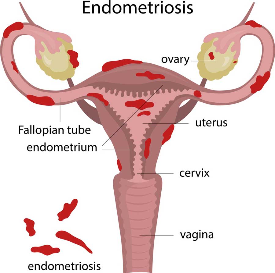 endometriose-befall