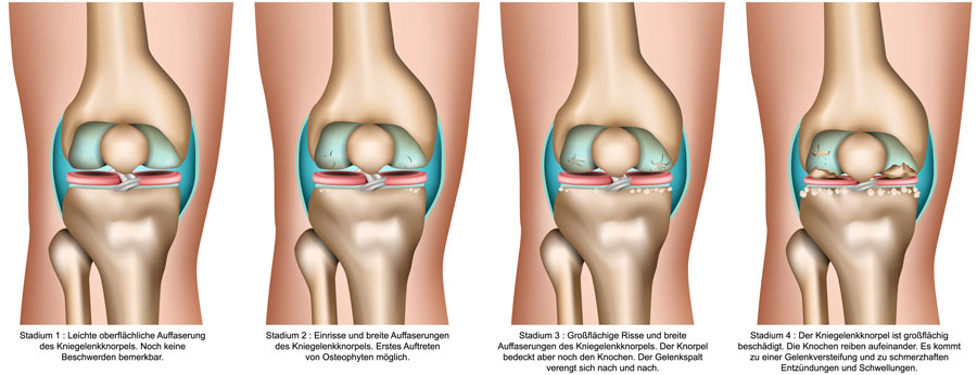 arthrose-knie