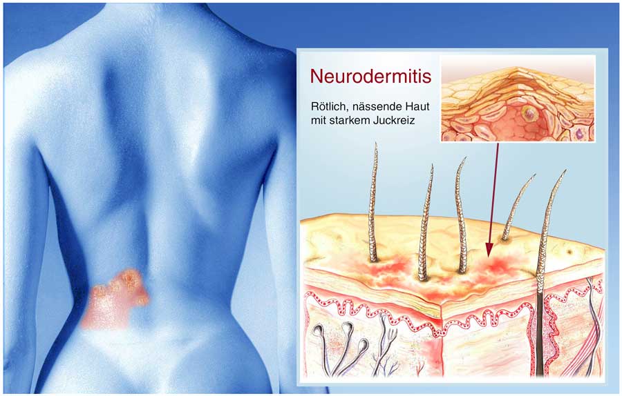 Neurodermitis 